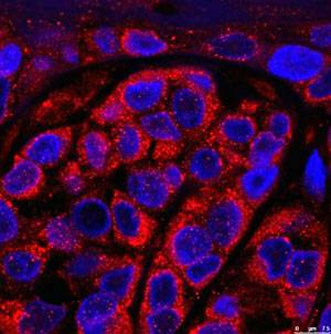 Cells from a biopsy of a patient with melanoma. In red, RAB7 protein accumulated in the endosomes of tumor cells. In blue, nuclei of tumor cells.